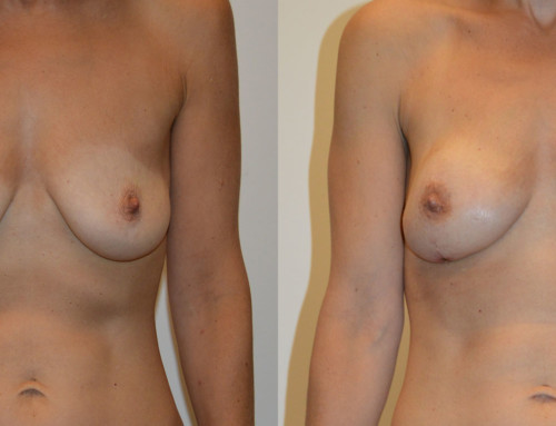 PAP Flap Reconstruction Before and After Photo by Joshua L. Levine, MD