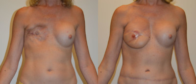 Front Diep and Pap Breast Reconstruction Before and After Photo