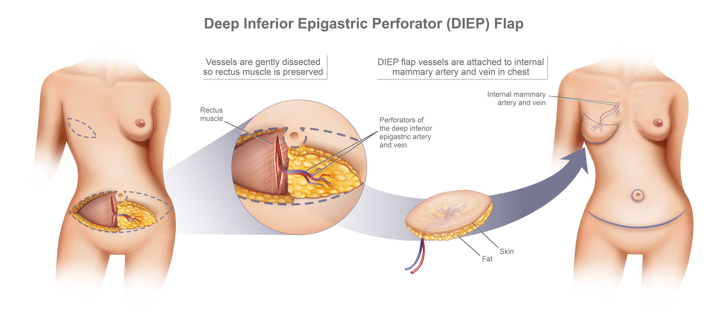 DIEP Flap Breast Reconstruction: What To Know