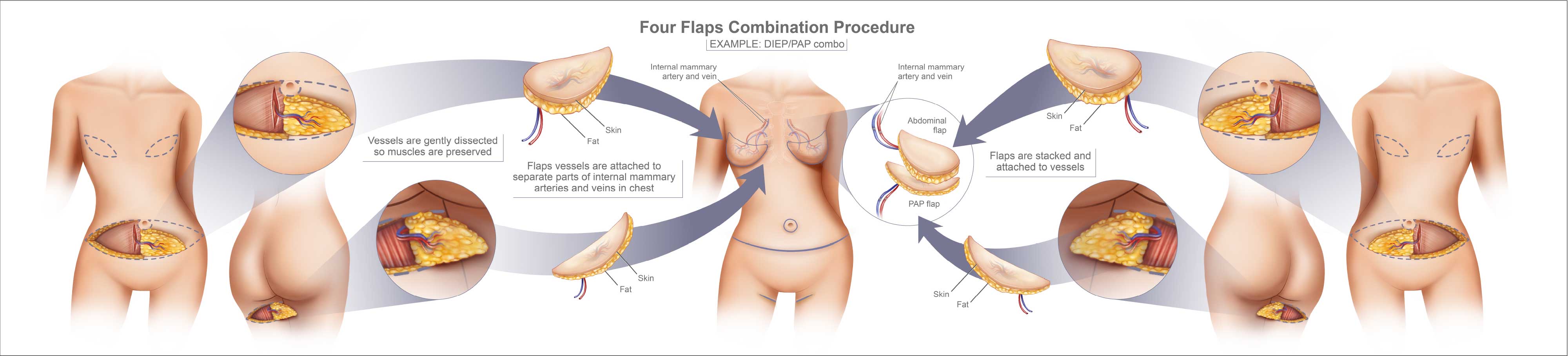 Illustration of Combo Flap Breast Reconstruction
