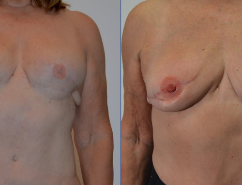 PAP Flap Breast Reconstruction Before and After Photo by Joshua L. Levine, MD