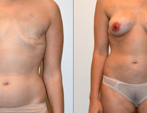 PAP Flap Breast Reconstruction Before and After Photo by Joshua L. Levine, MD