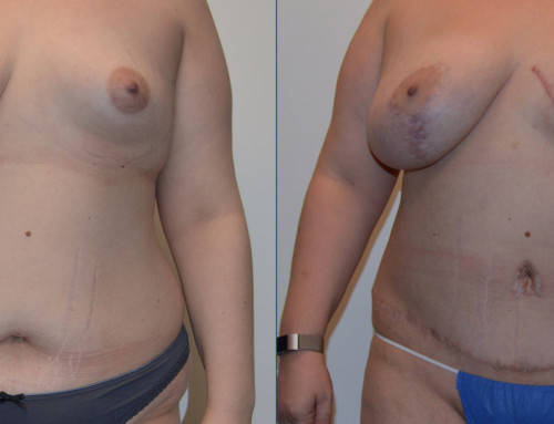 DIEP Flap Breast Reconstruction Before and After Photo by Joshua L. Levine, MD