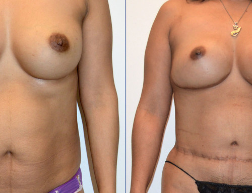 SHaEP Flap Breast Reconstruction Before and After Photo by Joshua L. Levine, MD