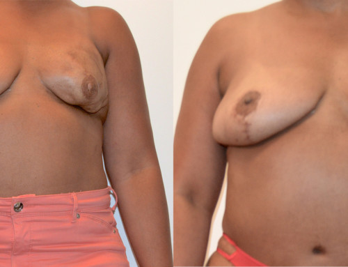 TDAP Flap Breast Reconstruction Before and After Photo by Joshua L. Levine, MD