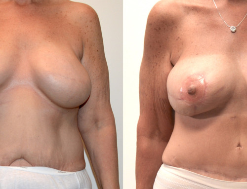 Stacked DIEP/PAP Flap Breast Reconstruction Before and After Photo by Joshua L. Levine, MD