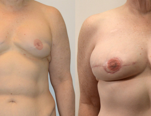 DIEP Flap Breast Reconstruction Before and After Photo by Joshua L. Levine, MD