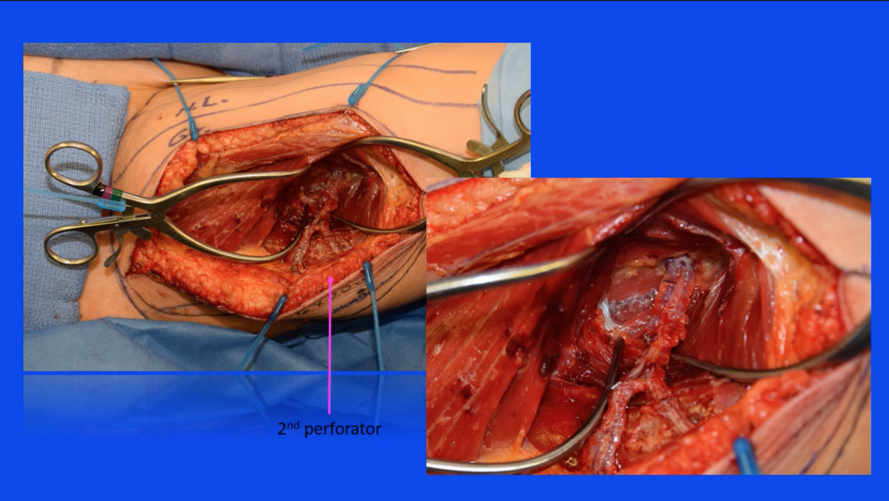 DIEP Flap Connected To Internal Thoracic Artery via Microsurgical