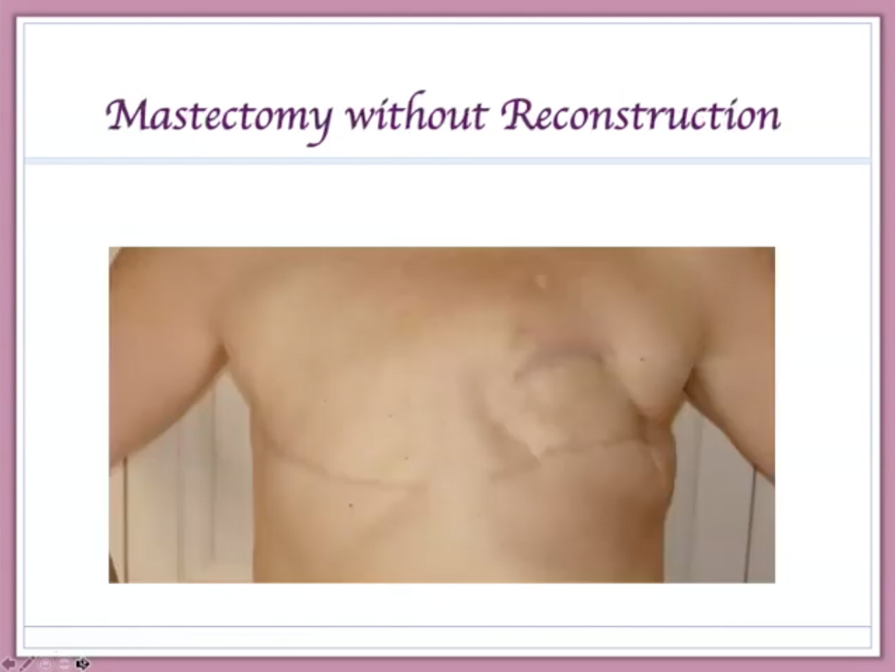 Bras Mastectomy Without Reconstruction