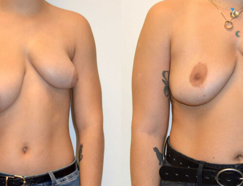 Poland Syndrome Breast Reconstruction Before and After Photo by Joshua L. Levine, MD