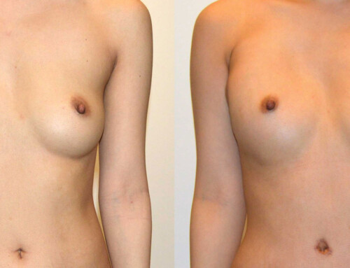Poland Syndrome – DIEP Flap Breast Reconstruction Before and After Photo by Joshua L. Levine, MD