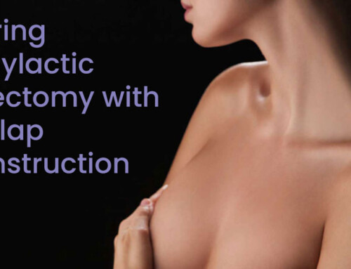 Exploring Prophylactic Mastectomy with DIEP Flap Reconstruction