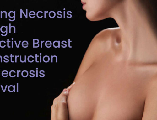 Treating Necrosis Through Corrective Breast Reconstruction and Necrosis Removal