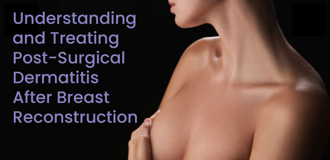 Articles and Presentations about Natural Tissue Breast Reconstruction